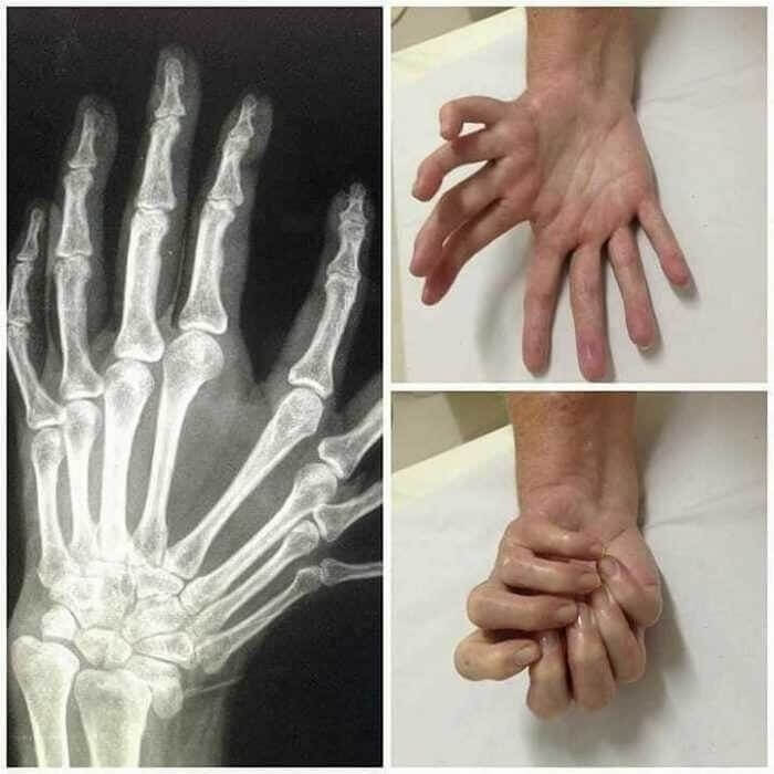 Mirror-Hand Syndrome